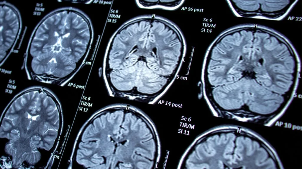 Il potenziale dell’AI contro le malattie rare: può  individuare le varianti genetiche responsabili