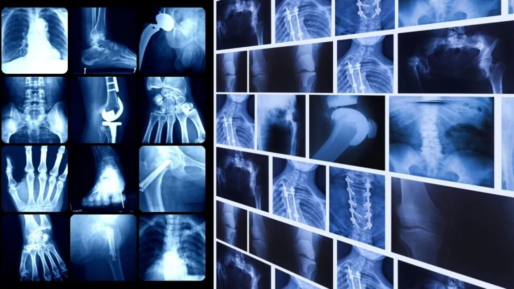 Radiografie reali o generate dall’AI? La RSNA lancia un quiz